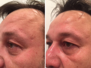 CooLifting Before and After Pictures