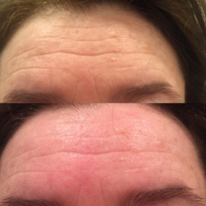 coolifting-before-and-after-pictures-forehead