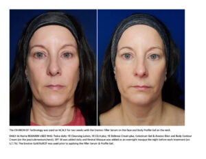 Environ DF Vitamin Infusion with the Filler and Neck Treatment