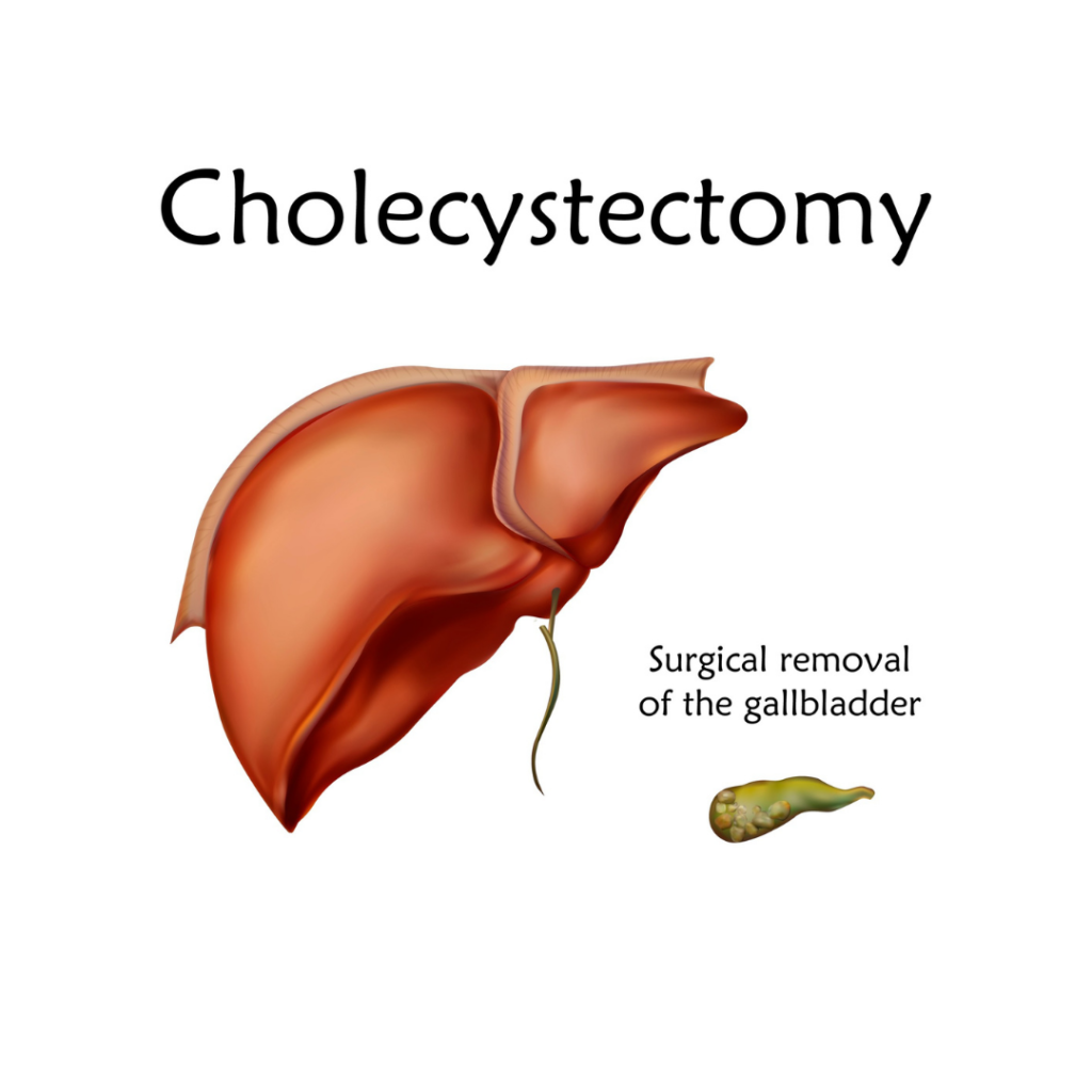 Cholecystectomy