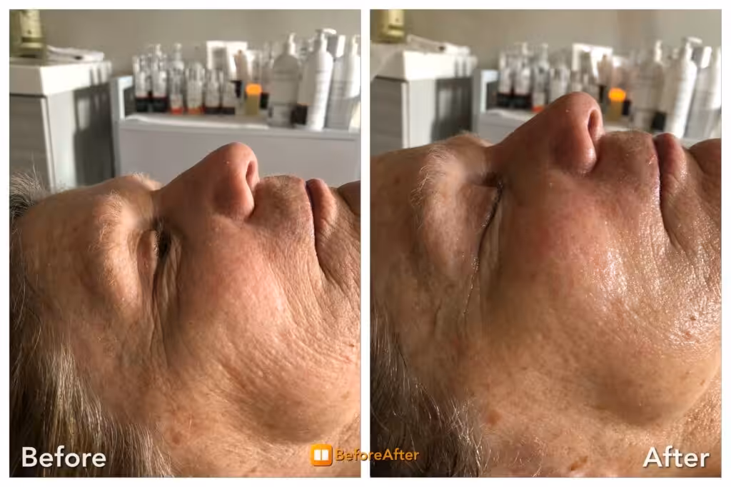 Results Gallery page showcasing before and after facial results