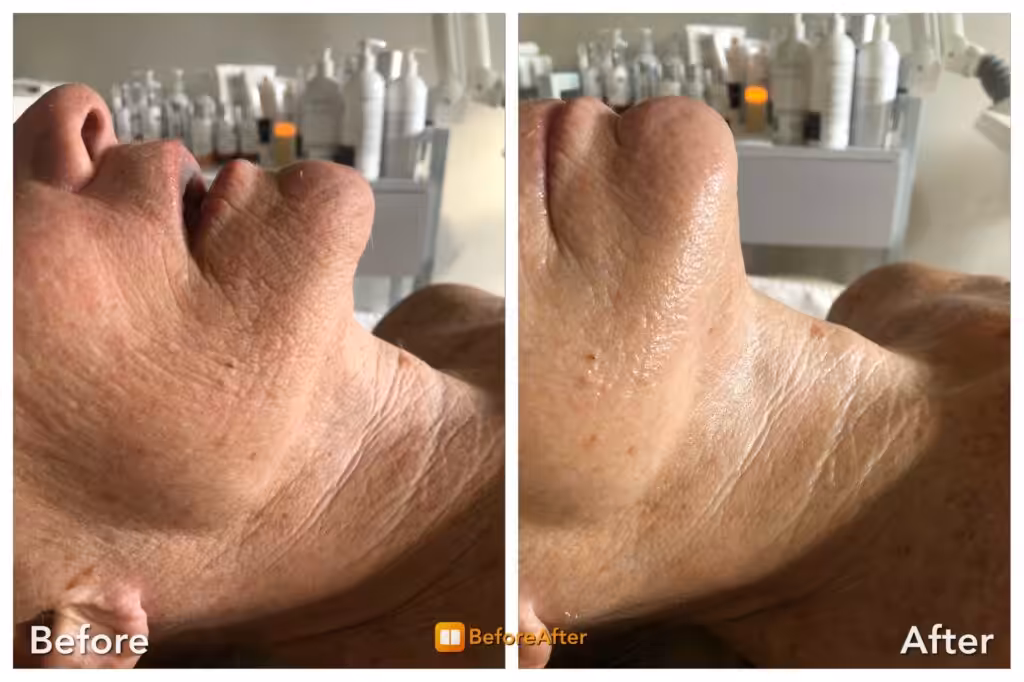 Best Facial in Boston