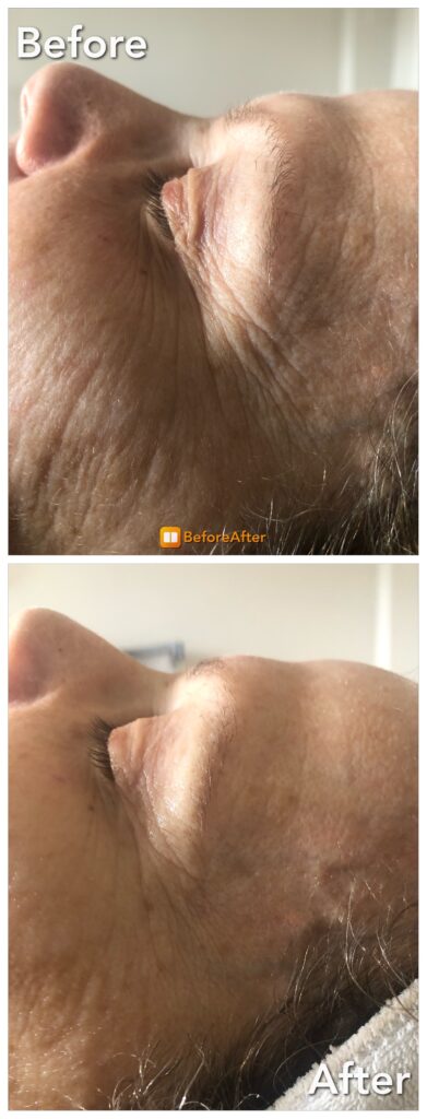 Award Winning Skincare Clinic Boston - results-oriented facial before and after picture