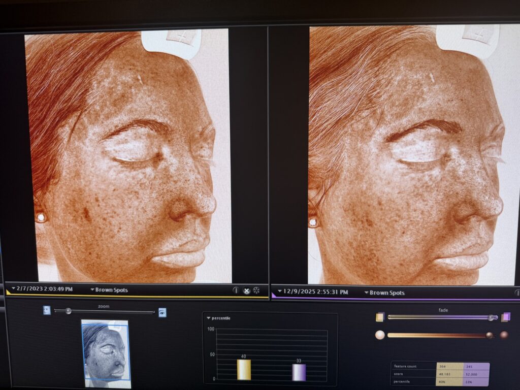 Functional Medicine Cellular Antiaging Detox for Hyperpigmenation