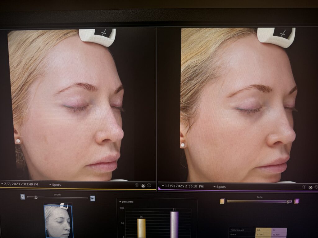 Cellular Functional Medicine Detox for Hyperpigmentation