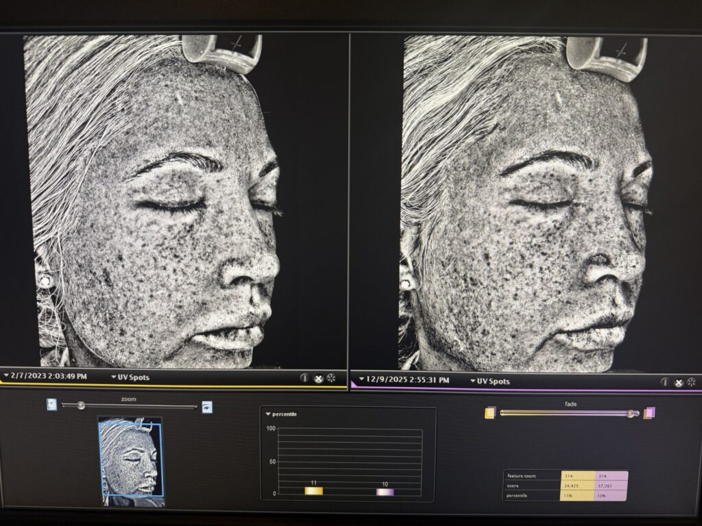 Cellular Functional Medicine Detox for Hyperpigmentation