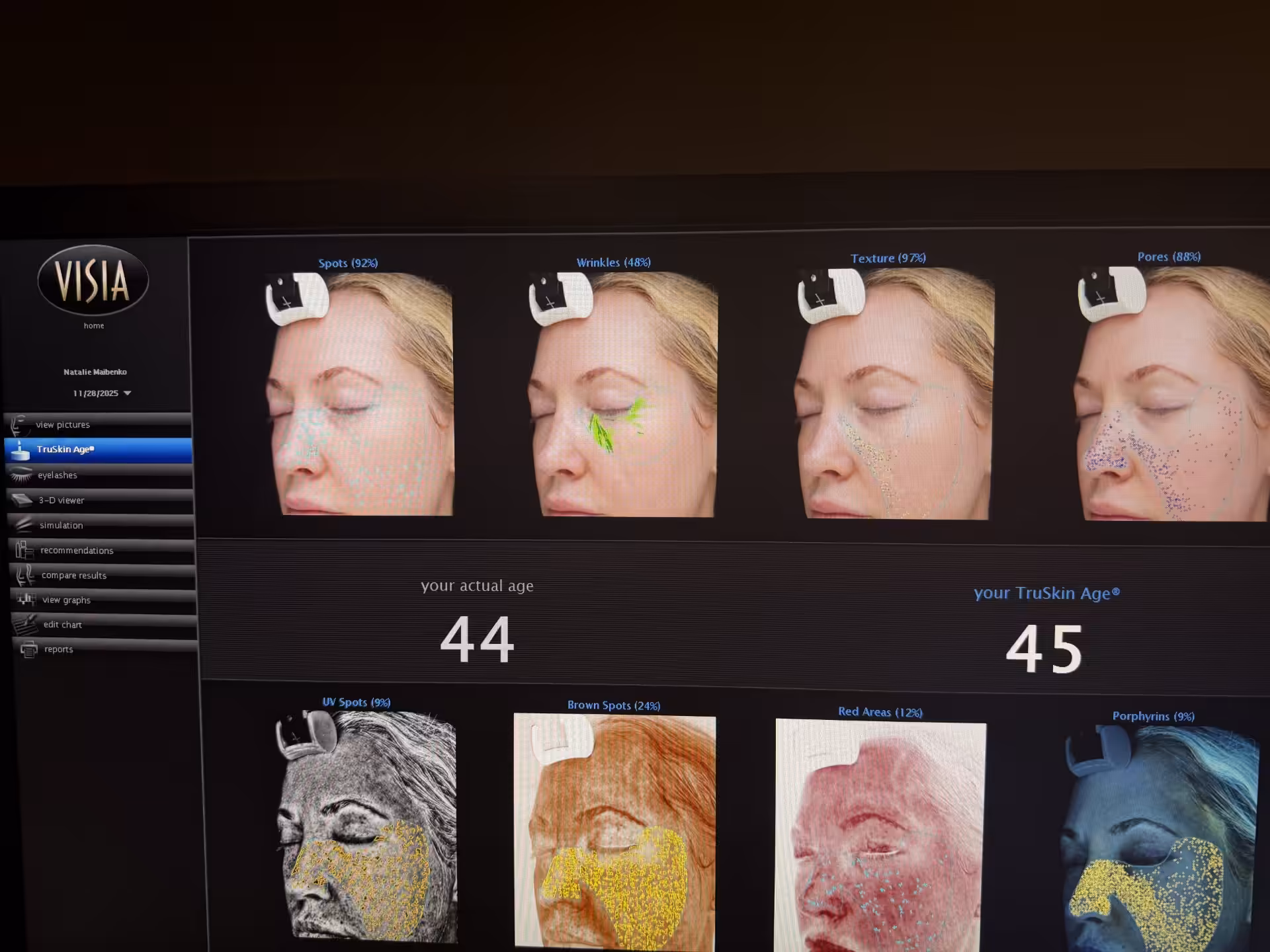 Cellular Functional Medicine Detox for Hyperpigmentation