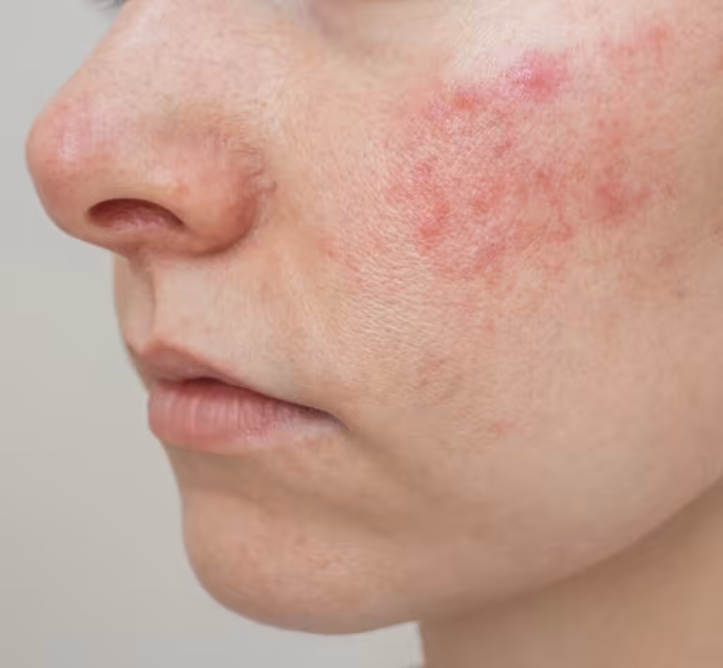 Rosacea Flares