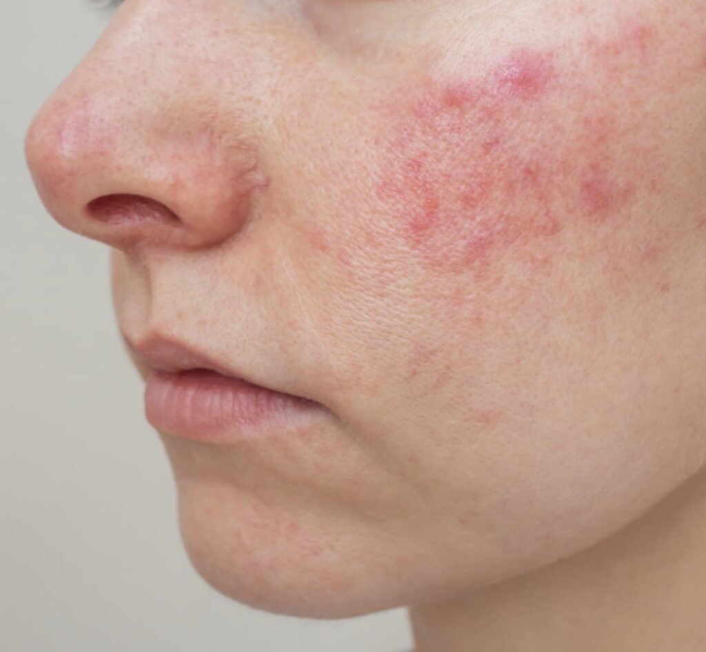 Rosacea Flares