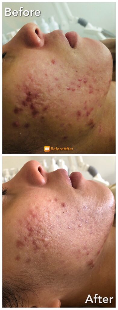 Visible acne skin improvement after corrective facial with functional medicine insight in Boston