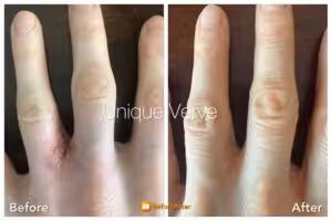 Visible improvement in eczema-prone skin following functional dermatology program