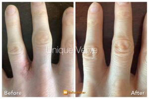 Visible improvement in eczema-prone skin following functional dermatology program