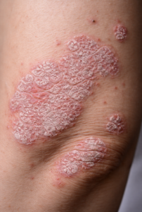 Psoriasis Treatment - Chronic plaque psoriasis with red inflamed scaly patches on the skin