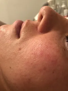 Healthy skin restoration, after