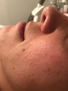 Healthy skin restoration, before