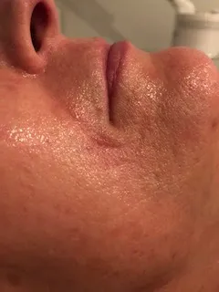 After personalized skincare program