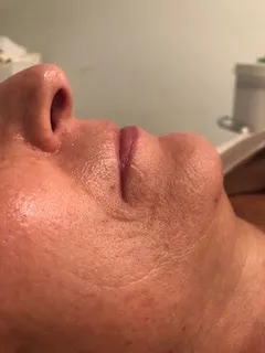 Before personalized skincare program