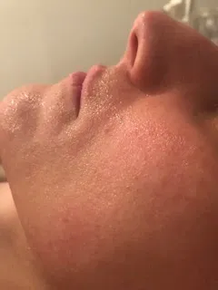 after Skin rejuvenation