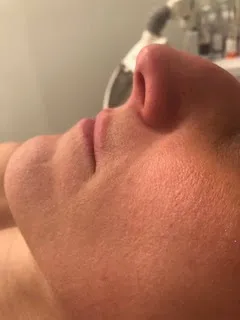 before Skin rejuvenation