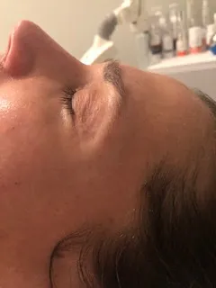 after skincare treatment results