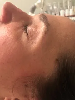 Before skincare treatment results