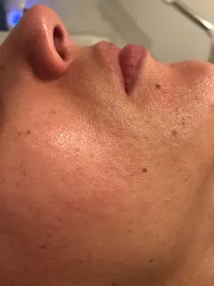 Facial skin improvement after treatment