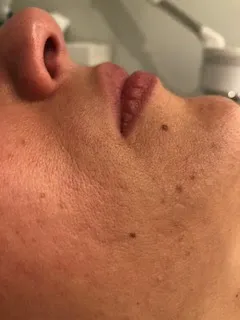 Before facial rejuvenation treatment