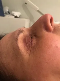 Skin texture prior to treatment