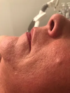 Functional dermatology client treatment, before