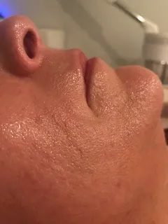 Results after corrective skincare treatment