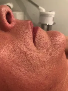 Before corrective skincare treatment