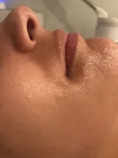 Post-treatment skin rejuvenation results