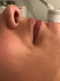Pre-treatment facial skin image