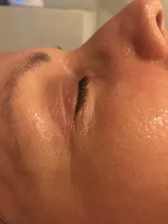 after Clinical facial treatment