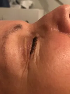 before Clinical facial treatment