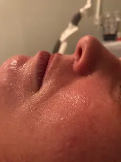 Skin texture after treatment