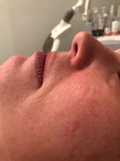 Skin texture before treatment