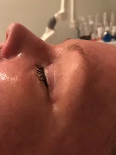 skin texture after treatment
