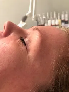 skin texture before treatment