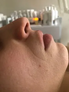 Before functional dermatology treatment