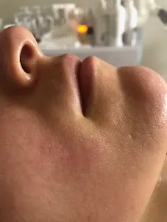 Improved skin texture after treatment