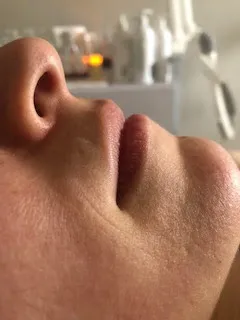 Initial skin condition before treatment
