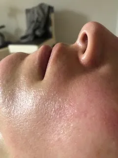 Results of Personalized skincare treatment at Unique Verve