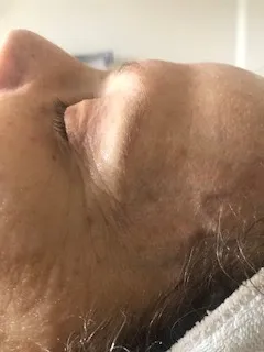 Fine lines after treatment