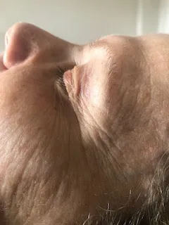 Fine lines before treatment