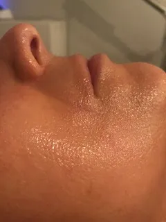 After skincare treatment results