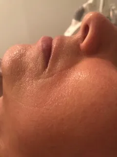 after Facial treatment