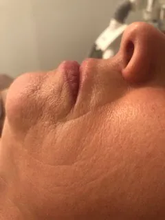 before Facial treatment