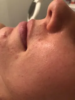 before skincare treatment with unique verve
