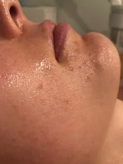 Acne treatment after